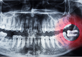 Illustration of wisdom teeth at the back of the mouth